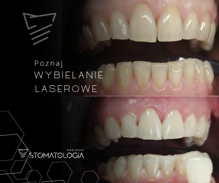 Nowość w Krajecki Stomatologia: laserowe wybielanie zębów laserem