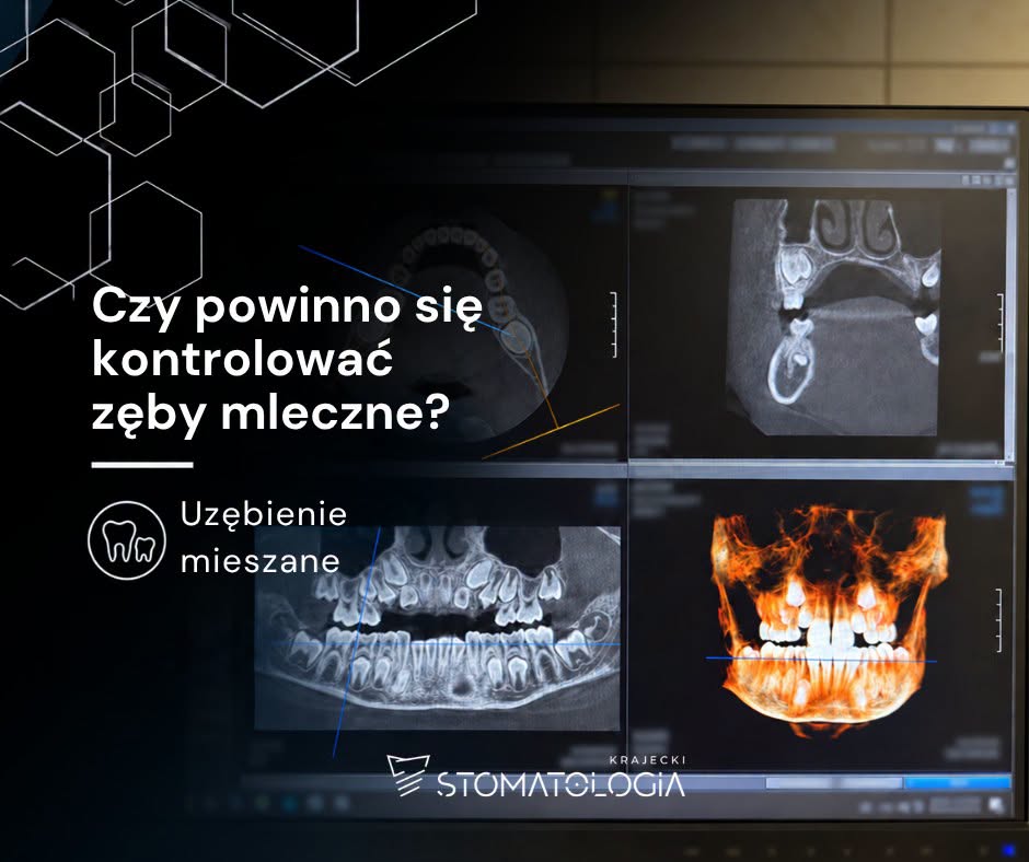 Uzębienie mieszane u dzieci – diagnostyka i rozwój